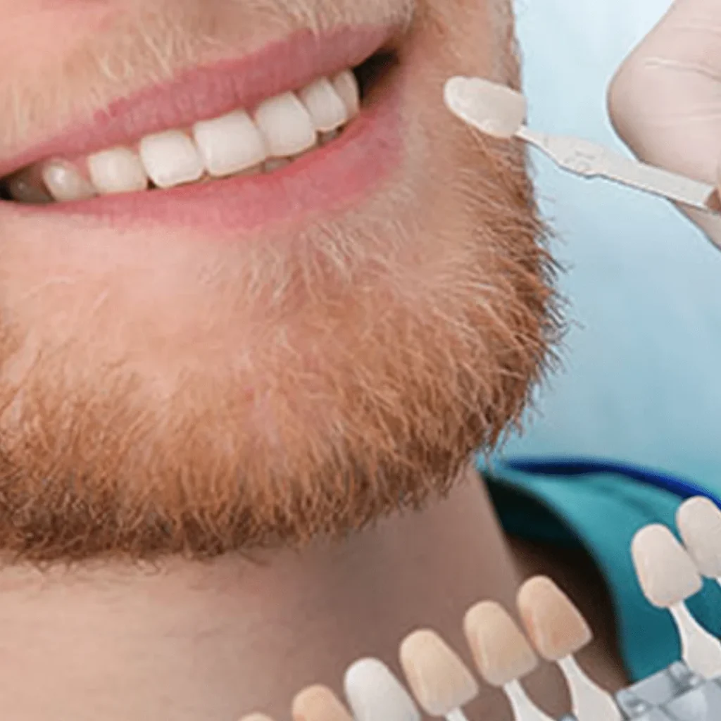 Faccette Dentali in Albania