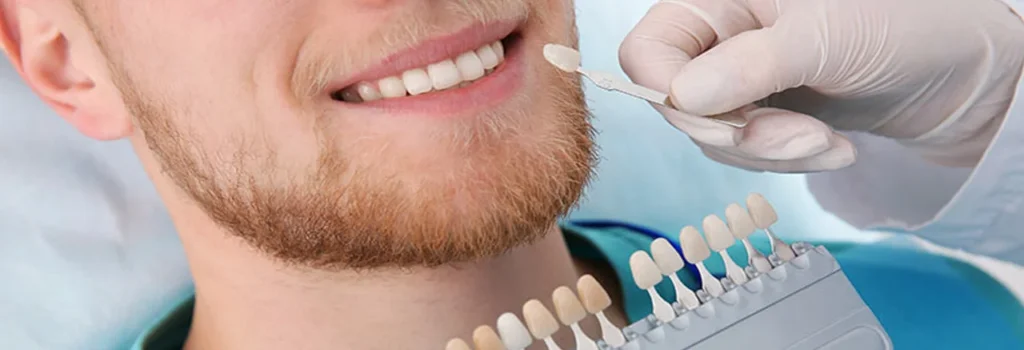 Dental Veneers in Albania