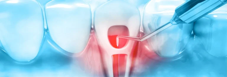 Endodonzia in Albania