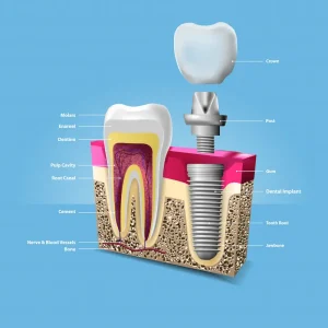 Quanto dura un impianto dentale