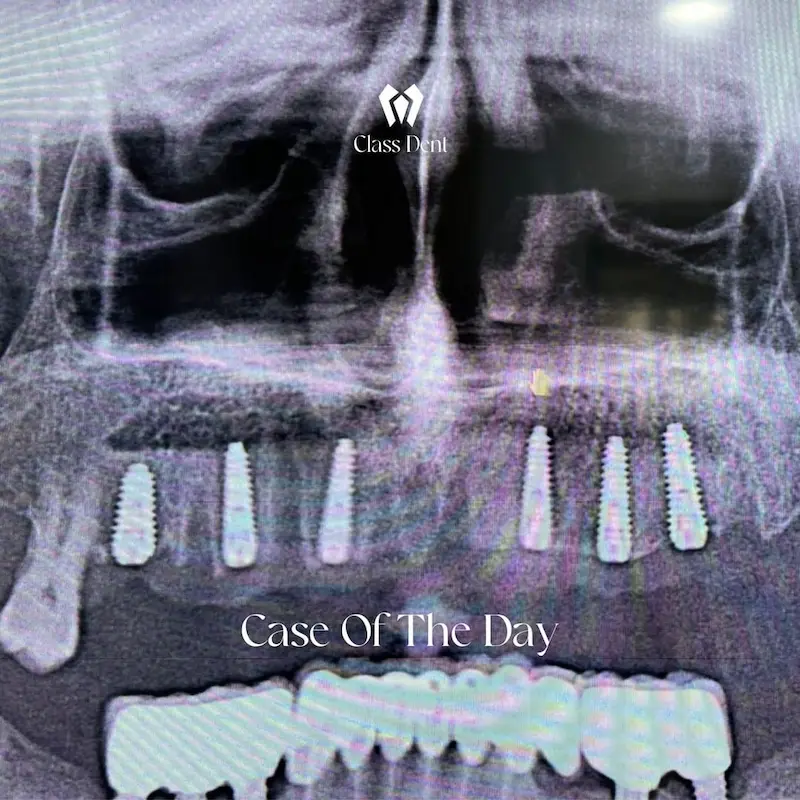 La vita quotidiana con gli impianti dentali