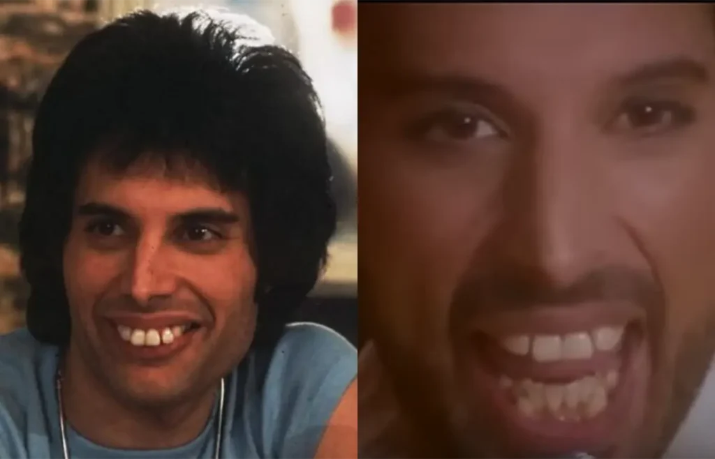 Freddie Mercury Denti