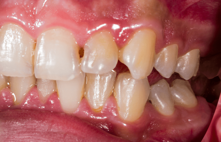 quanto costa curare una carie