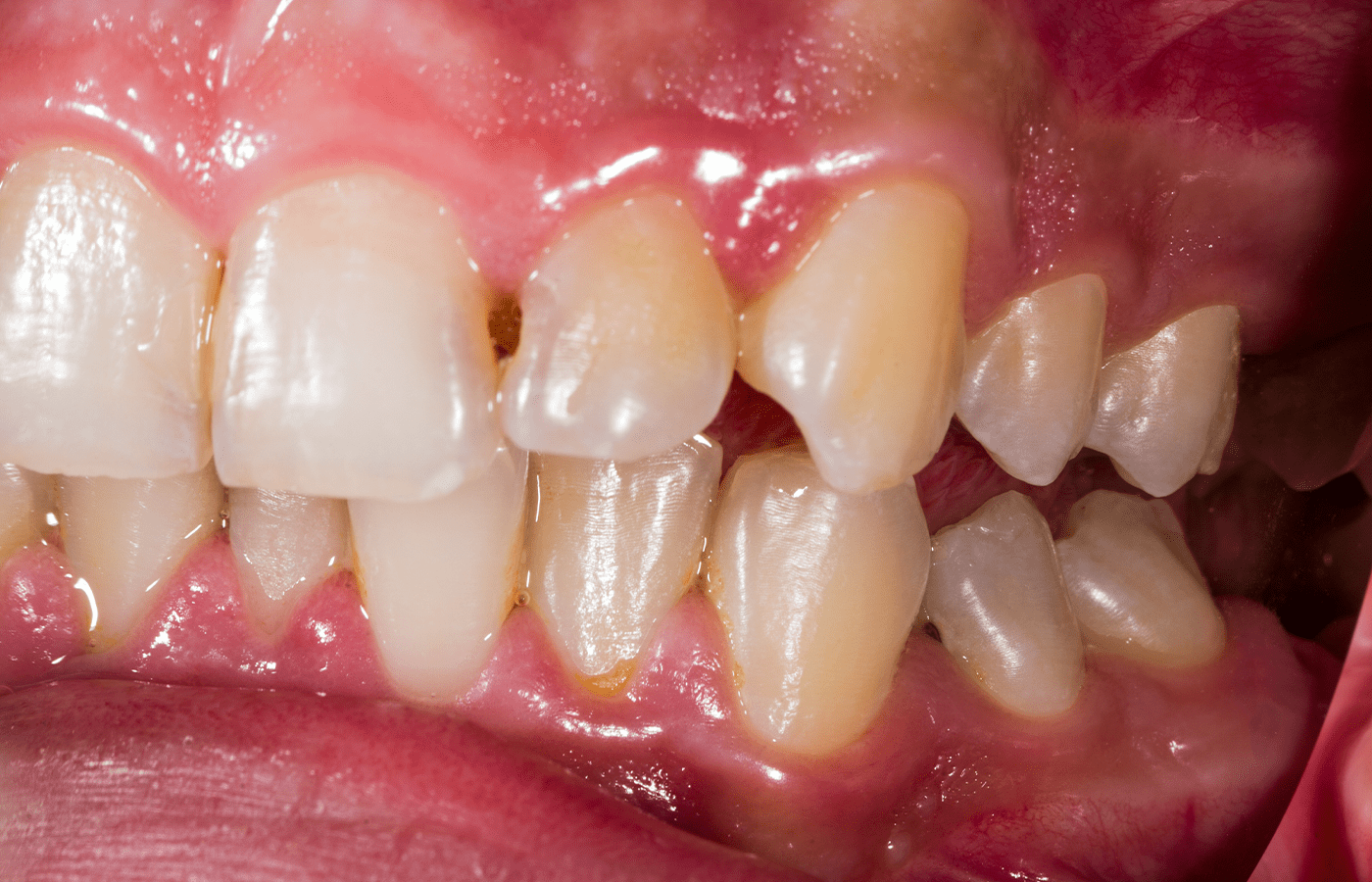 quanto costa curare una carie