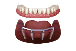 Dentadura Fija sobre 4 Implantes, Precio y Beneficios