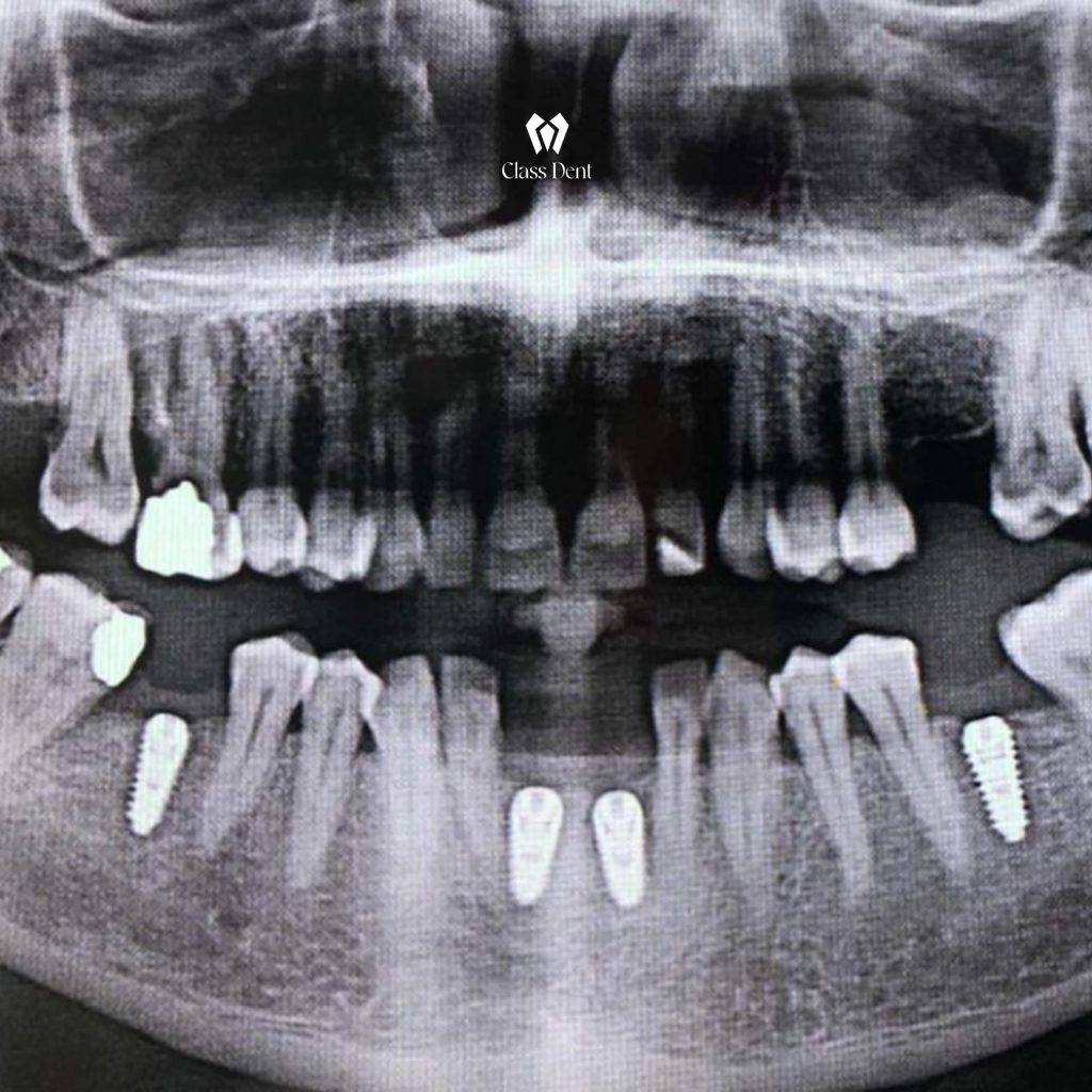 LLojet e implanteve dentale