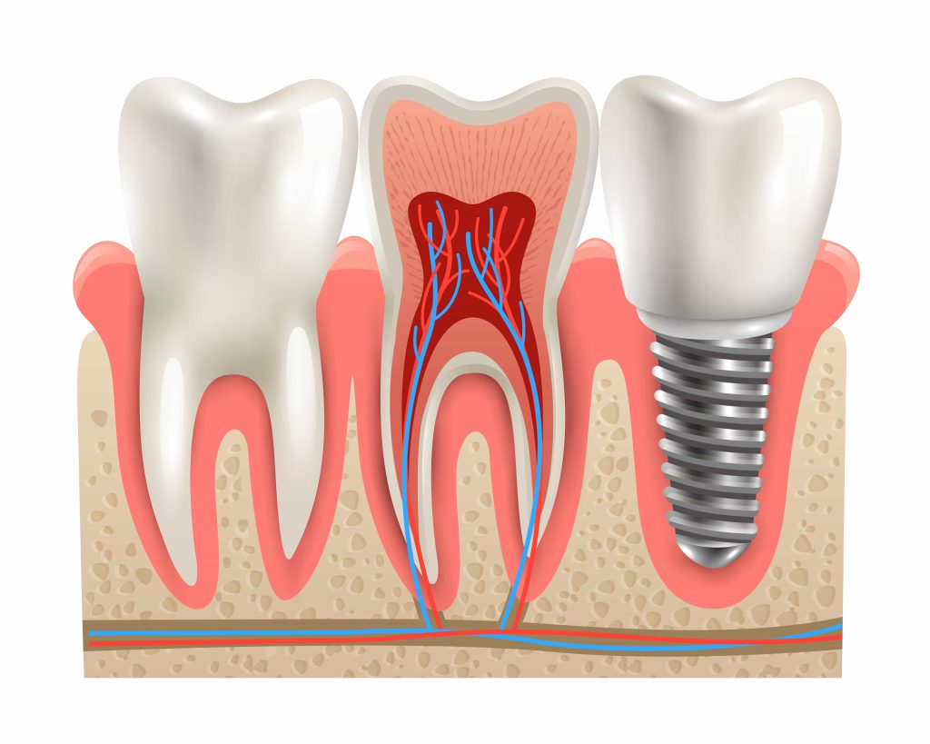 Implant apo Urë Dentare