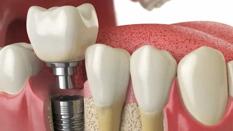 How Much Are Dental Implants