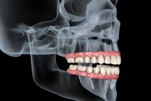 Dentadura Fija sobre 4 Implantes, Precio y Beneficios