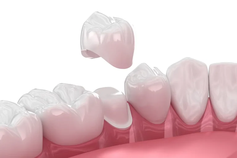 denti in zirconio pro e contro