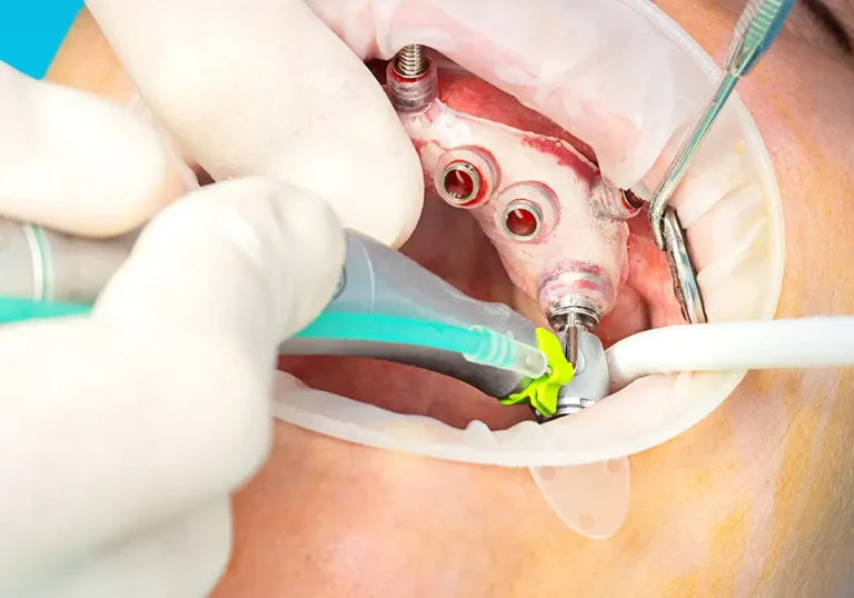 impianti dentali costi