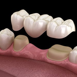 Implant apo Urë Dentare