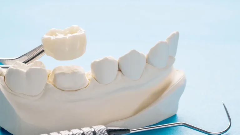 ¿Qué es una corona dental? Guía completa