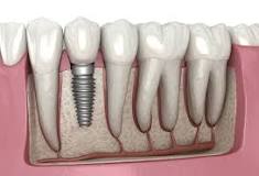 Dental Implants vs Veneers