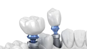 Teeth Implants Turkey