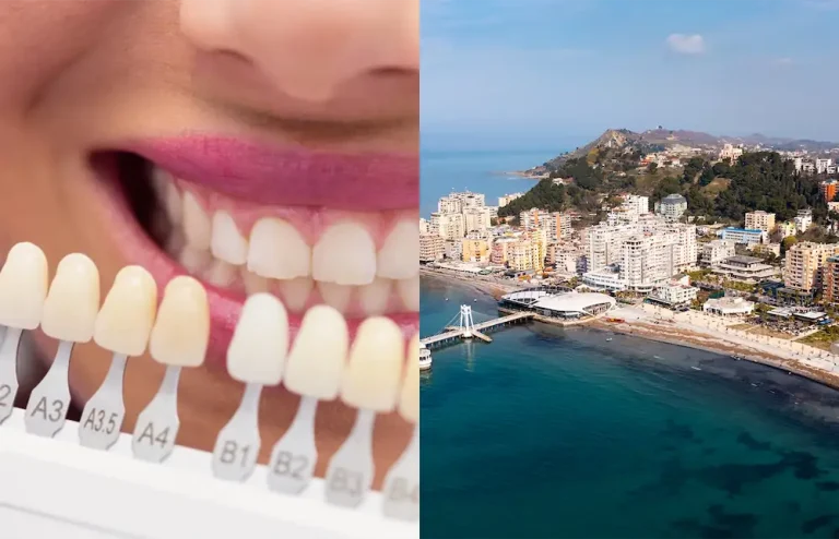 Price of Dental Veneers in Albania