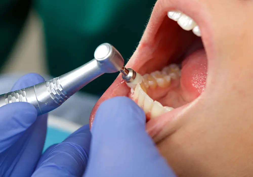 Impianto Dentale e Dolore