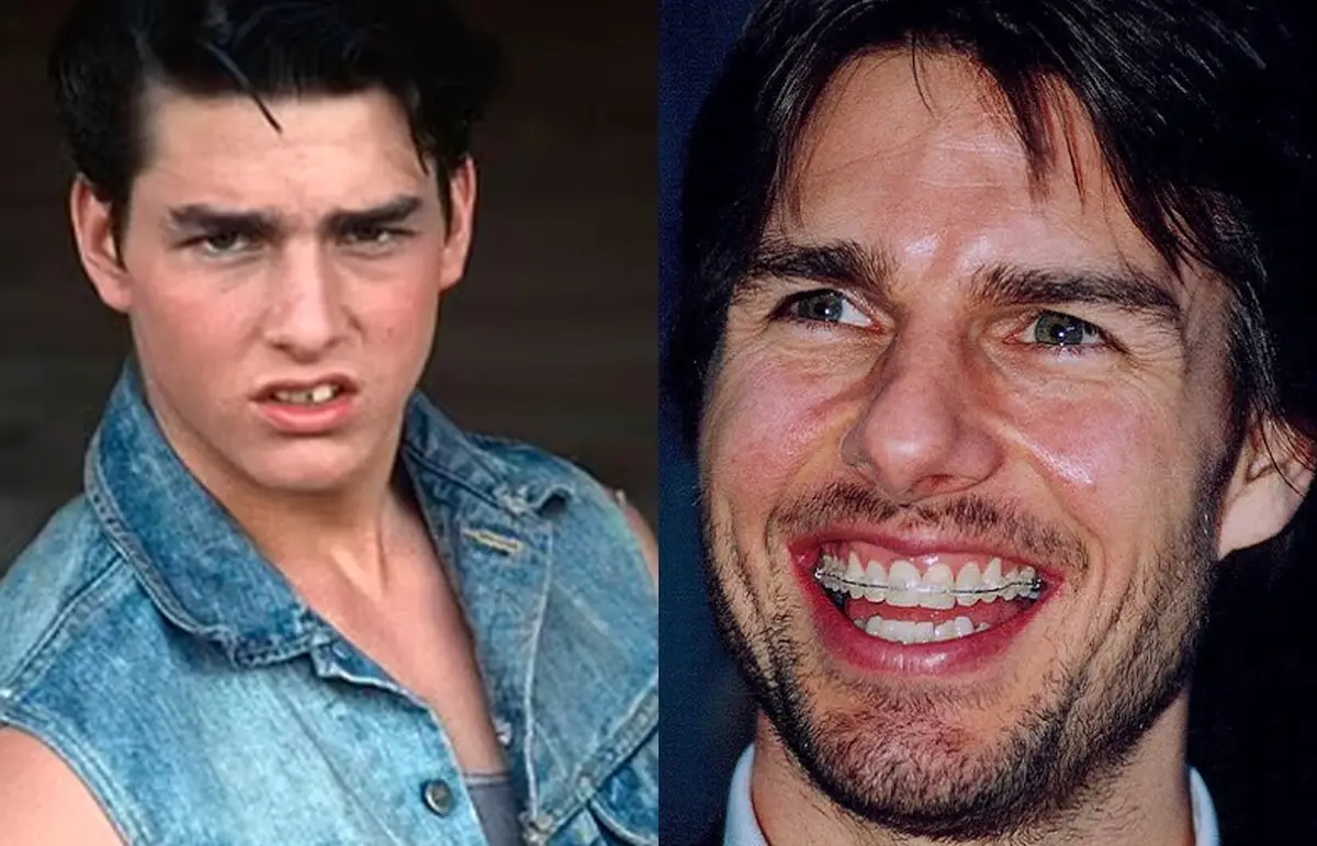 Tom Cruise Teeth