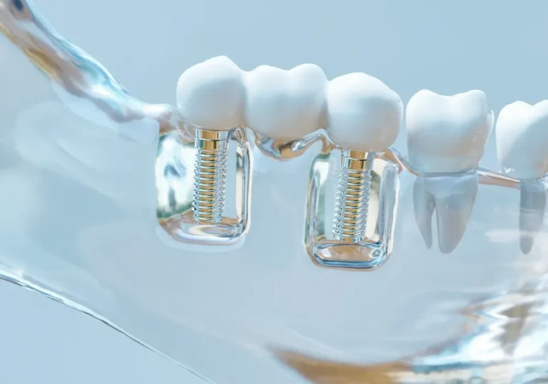 impianto dentale si vede la vite