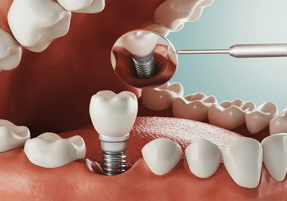 Teeth Implants Turkey