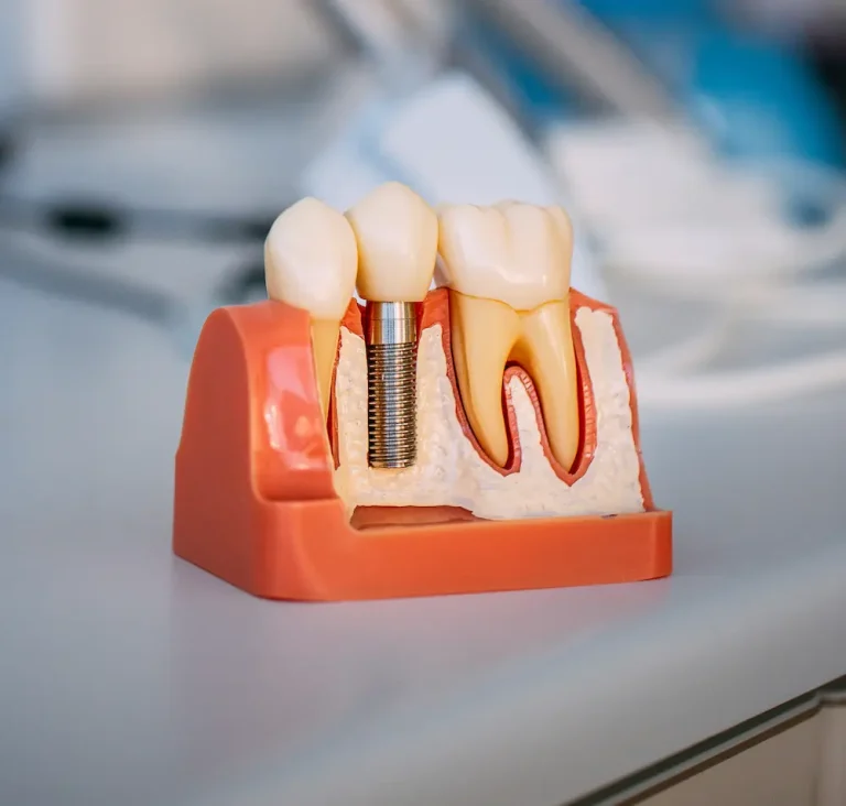 Quanto costa un impianto dentale