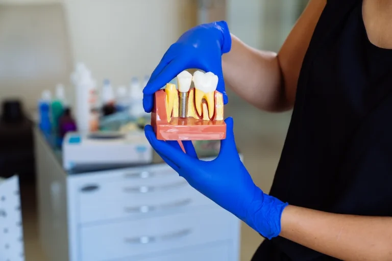 Quanto Costa un Impianto Dentale con la Mutua