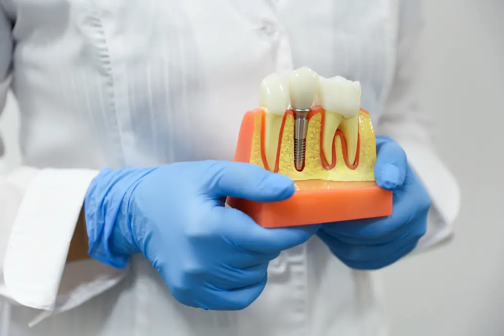 impianti dentali costi