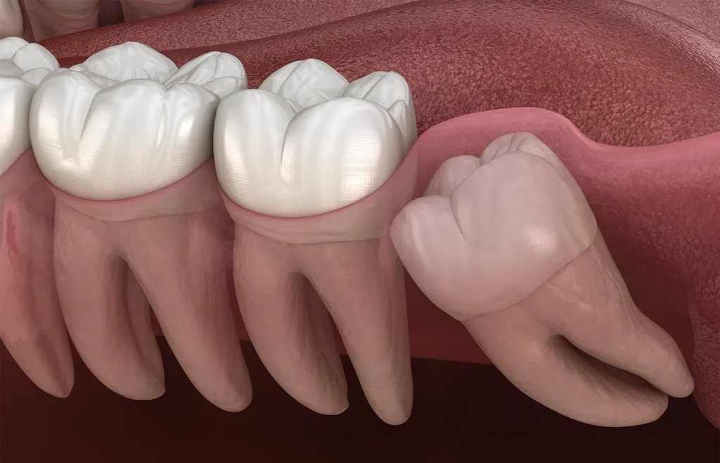 dente del giudizio che tocca il nervo sintomi