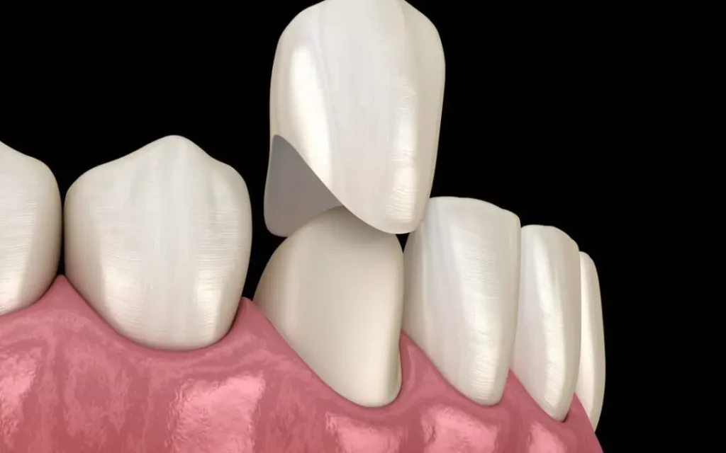 what is a dental crown