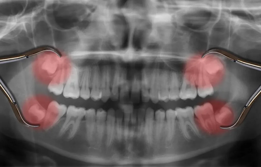 how to speed up wisdom teeth recovery