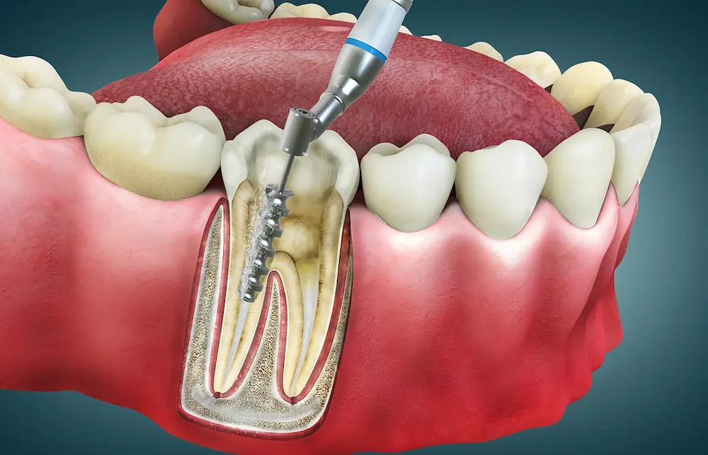 how long does a root canal take