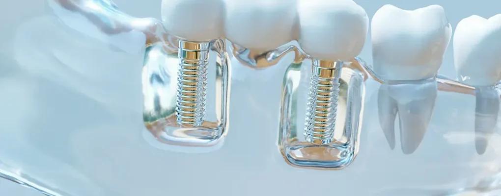 impianto dentale si vede la vite